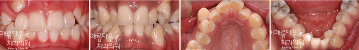 삐둘어진 치아 교정 이미지