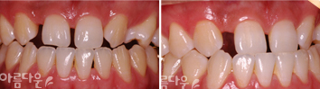 보철치료를 위한 교정 이미지