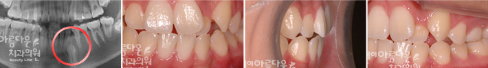 묻혀있는 치아 제위치 이미지